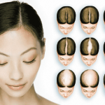 Female Pattern Baldness- What You Should Know