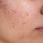 A Comprehensive Guide On Dealing With Acne